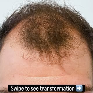 Swipe to see the transformation. Using the FUE (Follicular Unit Extraction) technique, we restored h