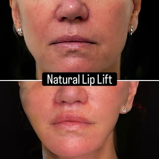 Sometimes, a few millimeters can completely change the harmony of the face.

This patient had a 20 m