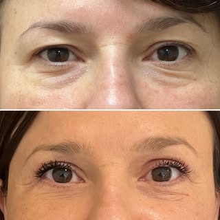 Under-eye bags don’t respond to creams — and filler only camouflages them. This is a lower blepharop