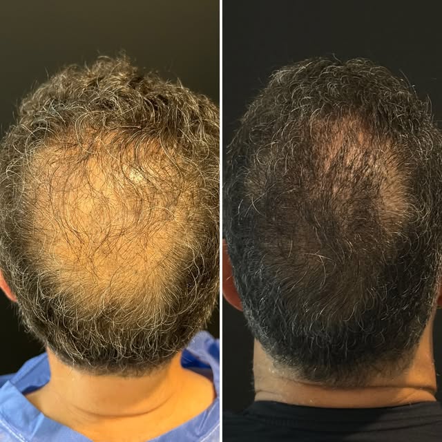 FUE Hair Transplant — DHI Technique | Crown Restoration 🔬

12 months post-op. Real patient, real re