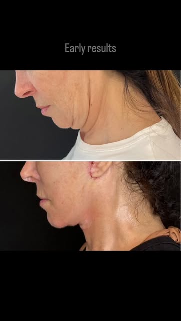 DEEP PLANE FACE & NECK LIFTING - neck and jawline.
These are early post-op photos. You can see the s
