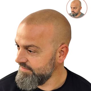 Micropigmentación capilar – Caso Rubén (Alopecia grado 7) Efecto afeitado.
(Imagen: Antes y después 