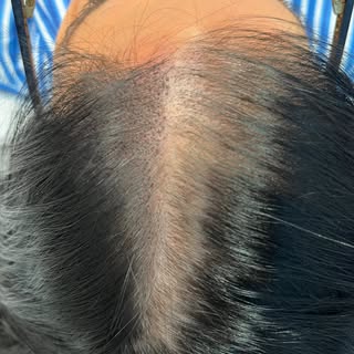 First Session of SMP‼️👌

#scalp #scalpmicropigmentation #smp #hairreplecement #hairsystem #skinfade