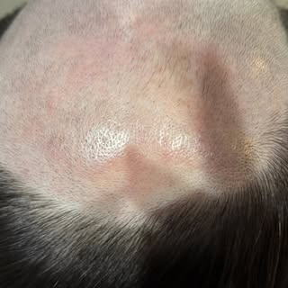 ✨ Hair Replacement Transformation! ✨ Discover the secrets to fuller, gorgeous hair! ✨ 

#HairReplace
