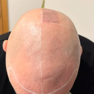 ✨ Check this out ! Here’s the journey of a 4-session scalp micropigmentation process. Watch to see t