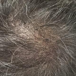 Work in progress 🤙🏽

#cofidence #smp #scalpmicropigmentation #london #hairloss #mensfashion