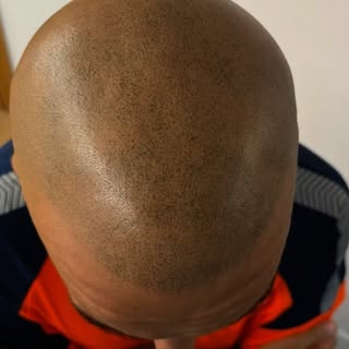 Touch up ‼️
SMP process 🤙🏽

#hairloss #cofidence #hairsystem #mensfashion #smp #scalpmicropigmenta