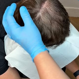 More Contrast🤟🏽

#hairloss #cofidence #smp #scalpmicropigmentation