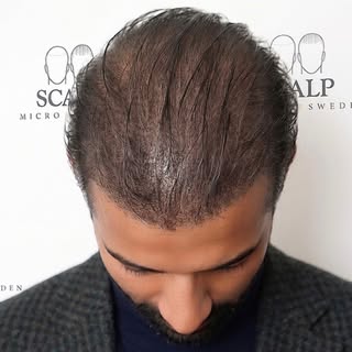 Från gleshet till totalt självförtroende. SMP är den ultimata lösningen för en modern look. Vill du 