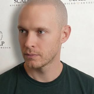Resultatet som förändrar allt. Naturligt, diskret och permanent. Ge dig själv den look du förtjänar.