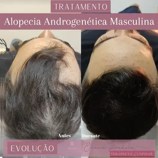 Que tal começar o sábado vom essa evolução de tratamento!?
.
🚨 Alopecia Androgenética tem tratament