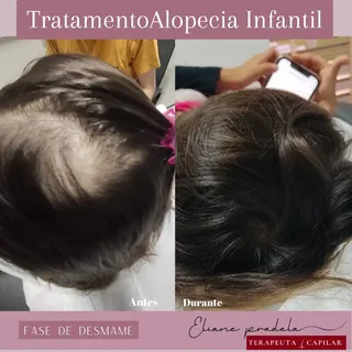 🙆 A tinha do couro cabeludo é uma infecção fúngica que causa uma erupção cutânea escamosa ou placa 
