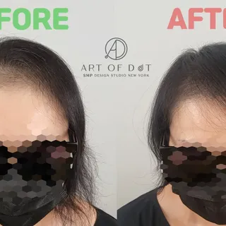 Adding Hair Density for Female Alopecia | 여자 탈모 전체 숱채움 | 뉴욕한인 SMP 두피문신 스튜디오 | SMP New York |

#미국두피문