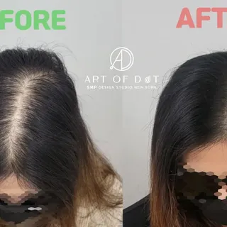 | Hairline SMP for Women in New York | 여성 가르마 정수리 | Scalp Micro Pigmentation| 미국 뉴욕 한인 SMP 전문 두피 문신 