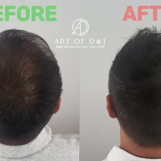 Hair Density for Men Hair Loss | 남자 헤어 정수리 숱채움 | 뉴욕한인 SMP 두피문신 스튜디오 |

#미국두피문신 #미국뉴욕두피문신 #미국smp #kor