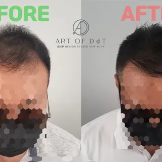 Adding Hair Density for Men's Hair Loss | 남자 정수리 숱채움 | 뉴욕한인 SMP 두피문신 스튜디오 | 

#미국두피문신 #미국뉴욕두피문신 #미국s