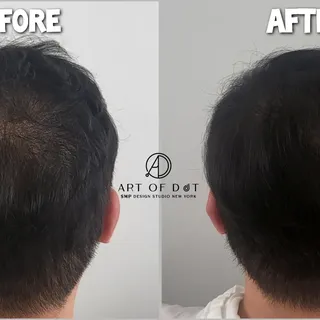 Adding Hair Density for Men | 남자 헤어 정수리 숱채움 | 뉴욕 한인 SMP 두피 문신 전문 스튜디오 | ART OF DOT SMP STUDIO NEW YO