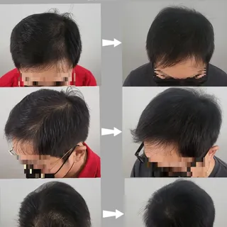 Adding Hair Density for Men Hair Loss | 남자 헤어 정수리 숱채움 | 뉴욕한인 SMP 두피문신 스튜디오 |

#미국두피문신 #미국뉴욕두피문신 #미국s