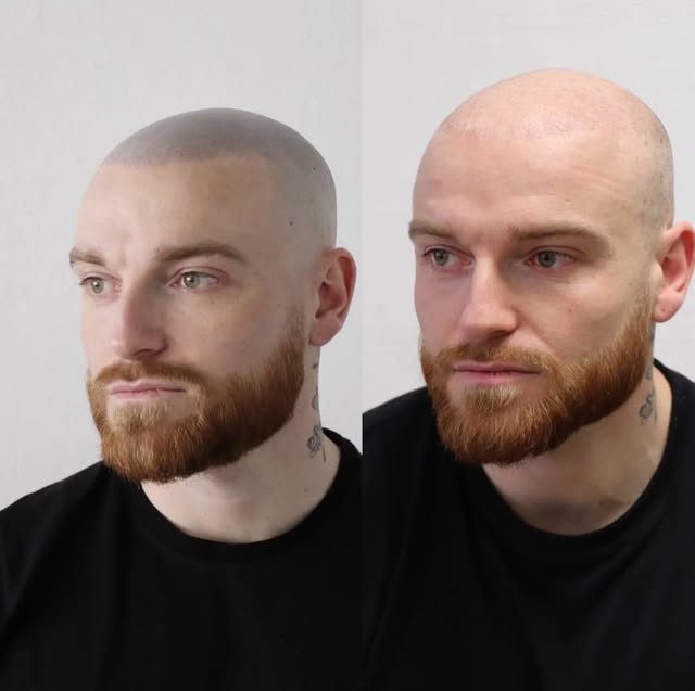 Découvrez le résultat de notre patient après son traitement SMP® un effet crâne rasé 3D ultra-réalis