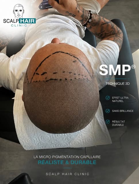 La précision au service du naturel. ✨

La technique SMP® 3D permet de recréer visuellement l’apparen