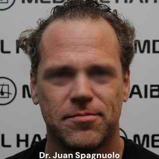 ¿Cuándo empiezo a ver resultados de mi implante capilar?🤔

El crecimiento del pelo implantado comie