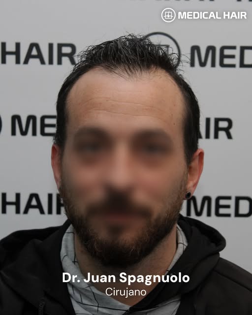 Restauración de la zona frontal mediante 2.100 unidades foliculares distribuidas con meticulosa prec