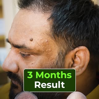 From Thinning to Thicker Hair: A 3-Month Transformation! 

Witness the step-by-step journey of a com