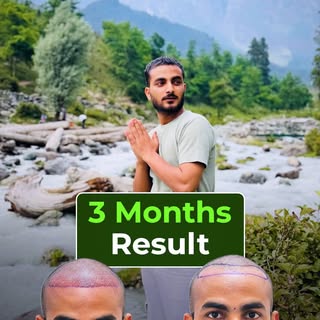 From hairline design to 3-month results ✨

Transformation takes time, but every single day is worth 