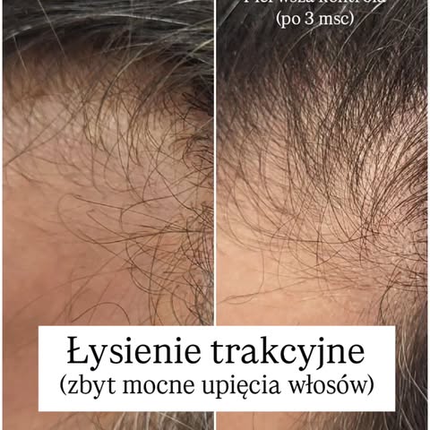 Łysienie spowodowane zbyt mocnymi i częstymi upięciami włosów w kitkę. Plus łysienie androgenowe. 

