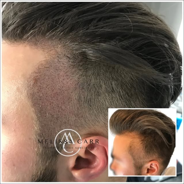 ✨ Scalp Micropigmentation (SMP) Transformation ✨

A natural-looking solution for thinning hair and v