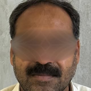 Hair Transplant: A fuller hairline can change everything

Book your hair transplant at Bellisima Cli