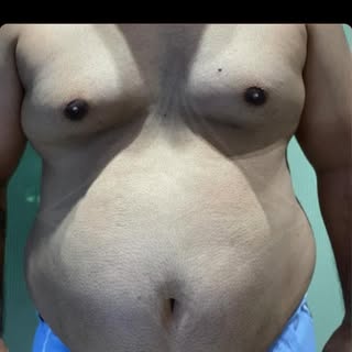 From stubborn fat to stunning shape.
Natural-looking liposuction results that speak for themselves.
