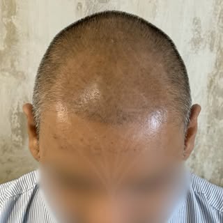 Wrong placement. Right correction. 

Restoring a natural hairline with precision, expertise, and att