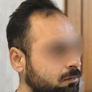 Still hiding your hairline?

It’s time to stop covering up and start growing your confidence back. E