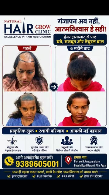 बालों का झड़ना नहीं, अब आत्मविश्वास की वापसी! 💇‍♀️✨
हेयर ट्रांसप्लांट के बाद 6 महीने का परिणाम — प्