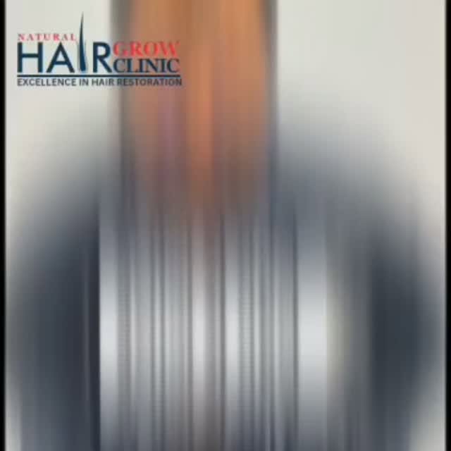 6 महीने का Hair Transplant Result — बदलाव साफ़ नज़र आ रहा है! 😍
जहाँ पहले hairline और density की कम