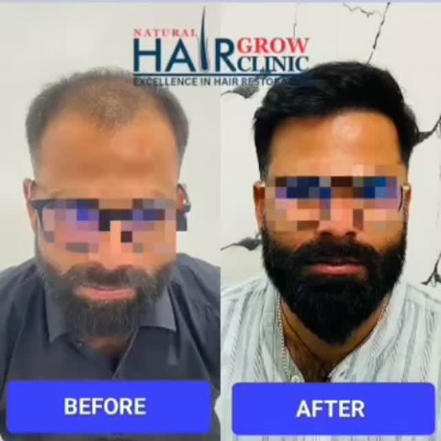 ✨ 6 Months Hair Transplant Result! ✨
From thinning hair to a fuller, more natural-looking hairline! 