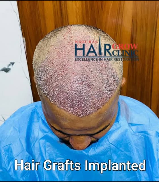🧑‍⚕️ Hair Transplant – Grafts Successfully Implanted ✨
एक-एक graft, बेहतर hairline की ओर एक कदम! 🌱