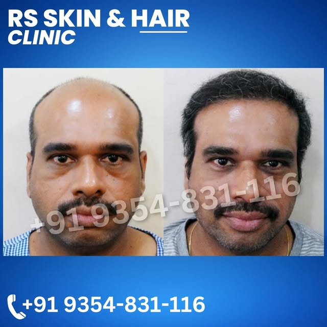 From bald to bold  #hair #hairstyle #haircut #hairstyle #hairstylist #beardtransplant #hairtransform