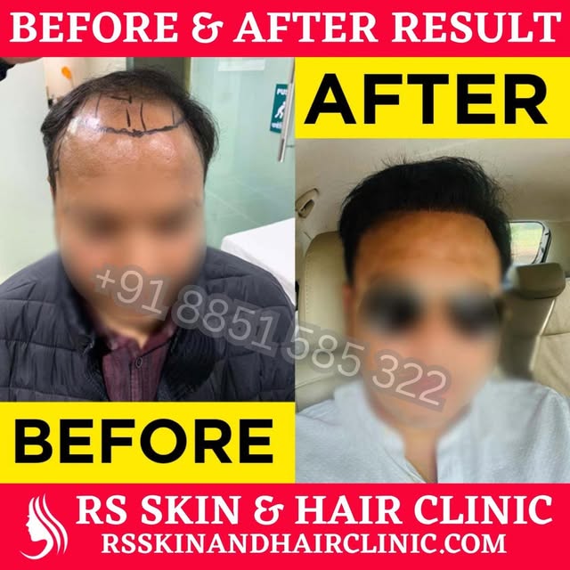 #hairstyles #hair #hairtransformation  #hairtransplantbeforeandafter #hairreplacement #hairrrplaceme