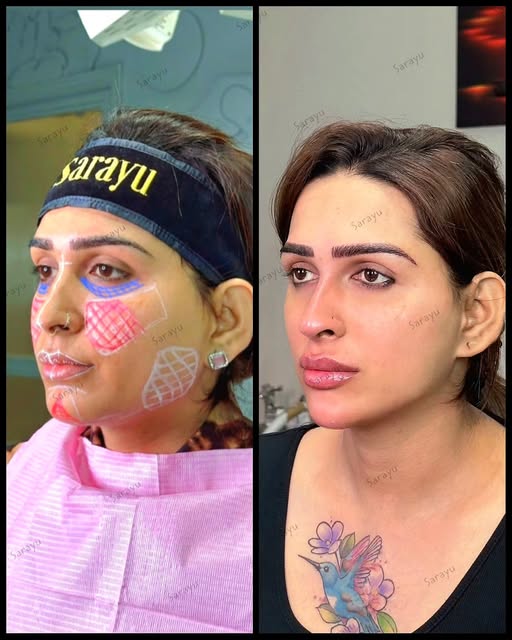 Non-Surgical Full Face Sculpting at Sarayu Clinics by Dr. Adarsh Tripathi’s advanced techniques make
