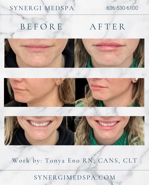 We are a sucker for a nice, full lip. Tonya does a spectacular job at balancing the lips and adding 