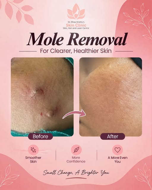 Sometimes, a small change can make a big difference. ✨

This mole removal transformation shows how p