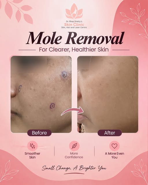 ✨ Small change, smoother skin, renewed confidence. ✨

Moles can be a part of your skin story, but if