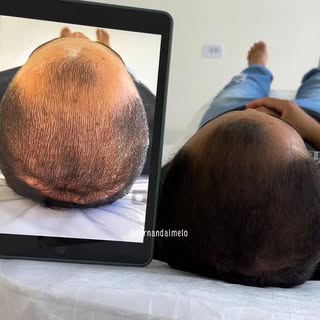 Resultado de meses de tratamento SEM TRANSPLANTE CAPILAR!! Apenas com meu protocolo realizo no consu