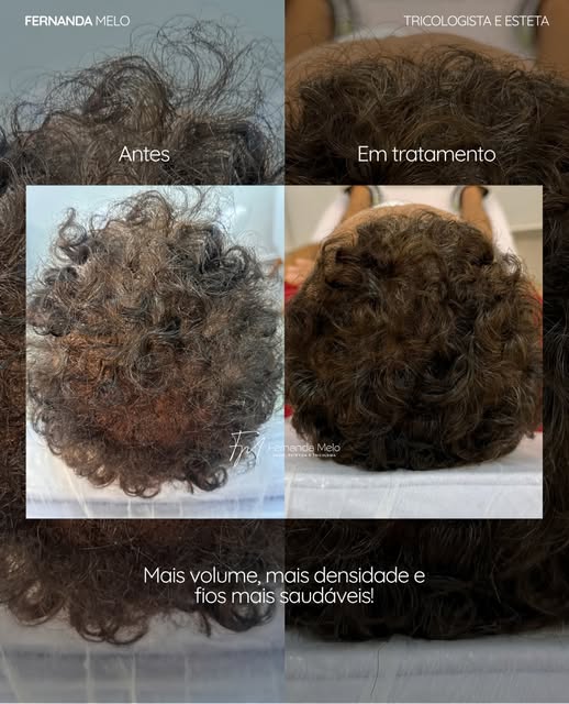Este paciente já havia passado por um implante capilar, e também já havia mantido seu tratamento com