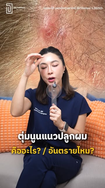ปลูกผมแล้ว “แนวผมเป็นตุ่มนูน” แบบนี้ปกติไหม? 👀

คลิปนี้มาดูว่า ตุ่มนูนหลังปลูกผมเกิดจากอะไรได้บ้าง 
