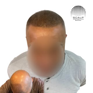 Amazing density fill in results! 

This clients significant hair thinning and daily cover up routine