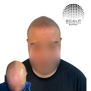 Absolutely amazing transformation! Perfect softer hairline for a 100% natural and undetectable resul
