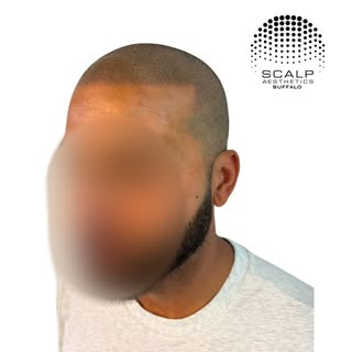 Natural and undetectable at its best! 

It’s hard to believe this client was losing his hair on the 